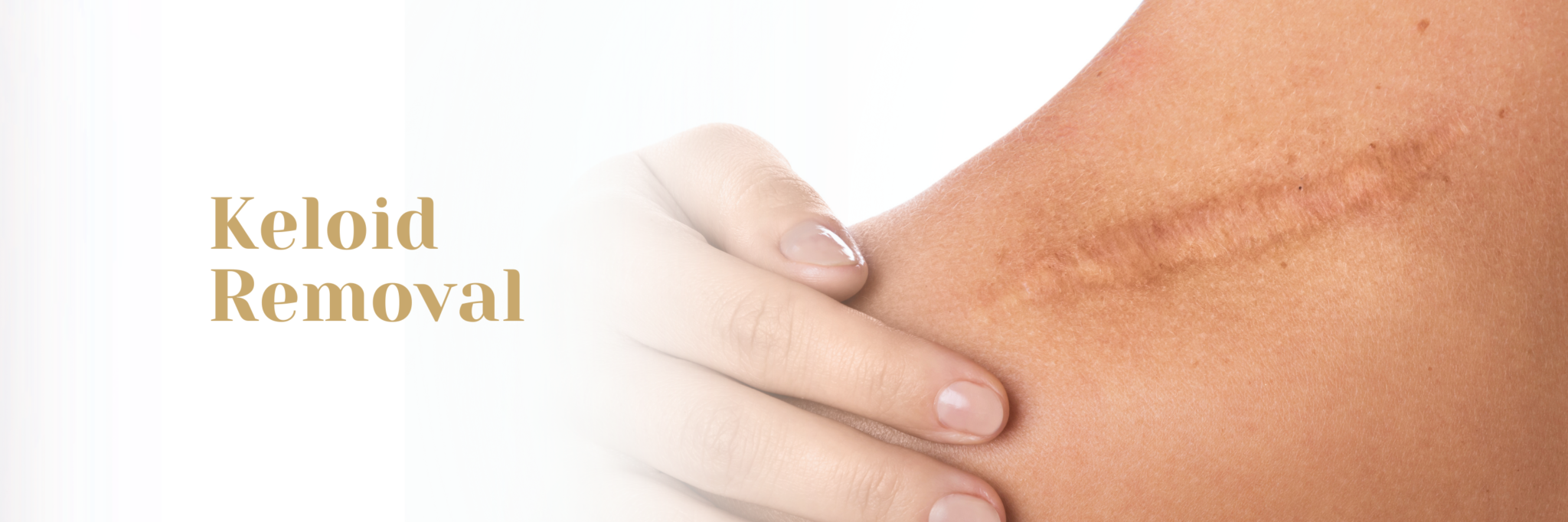 Keloid Removal (body) Glojas