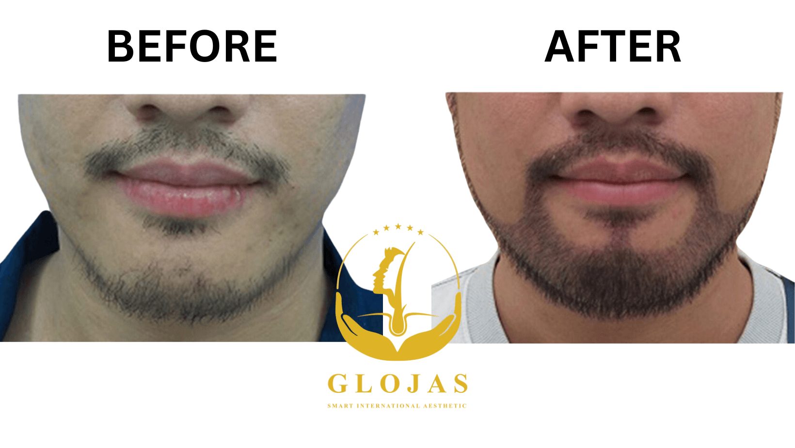 Beard Transplant