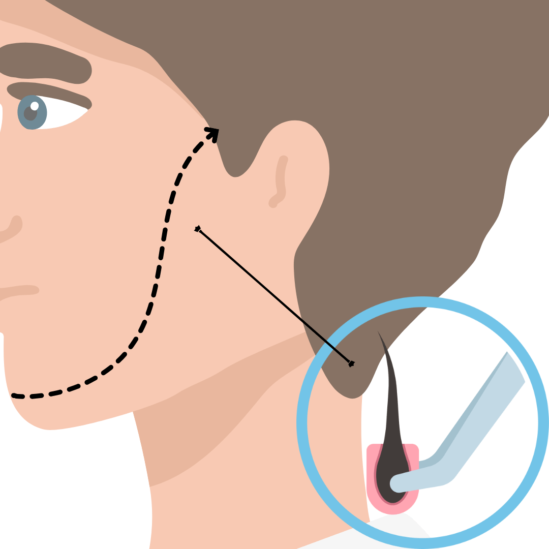 Beard Transplant
