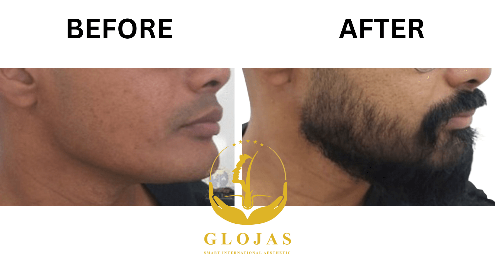 Beard Transplant