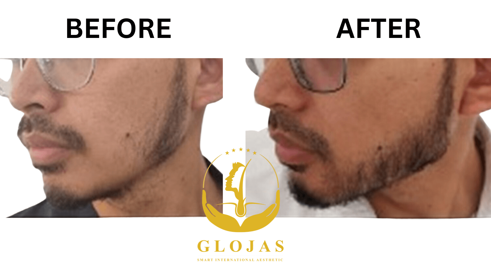 Beard transplant expert in Malaysia