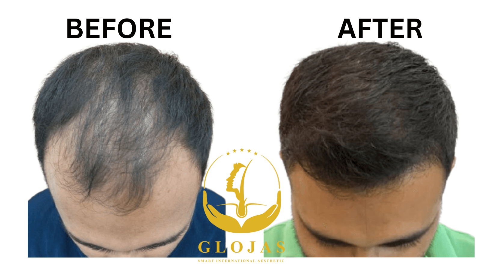 The best FUE Hair Transplant in Malaysia