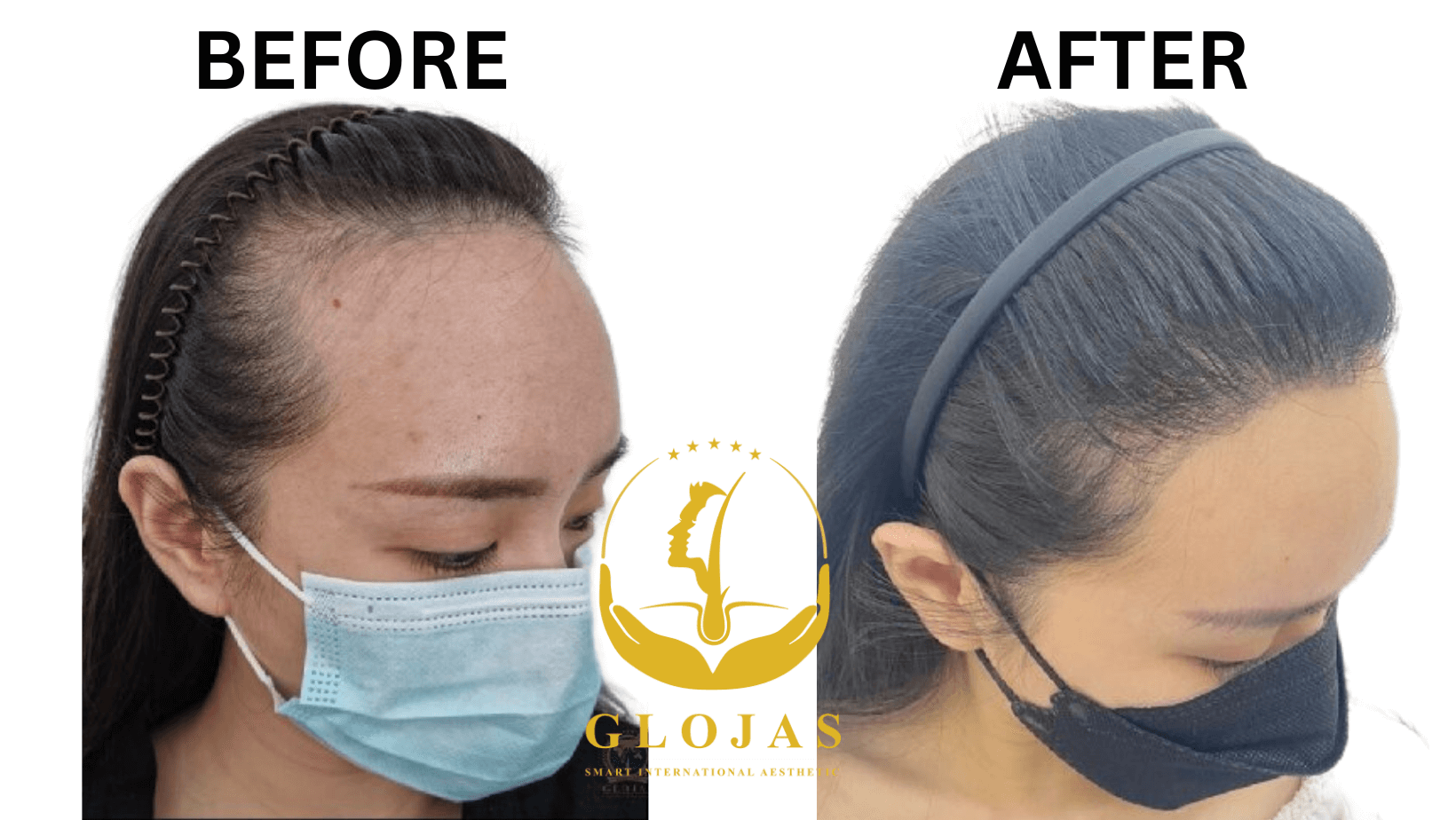 FUE Hair Transplant