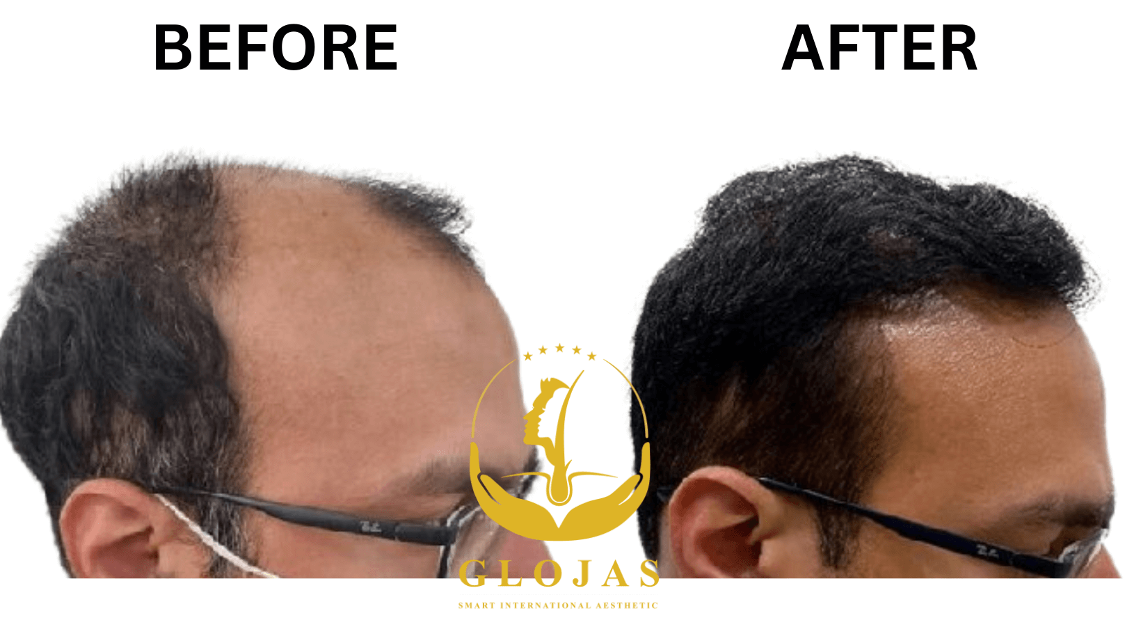 The best FUE Hair Transplant in Malaysia