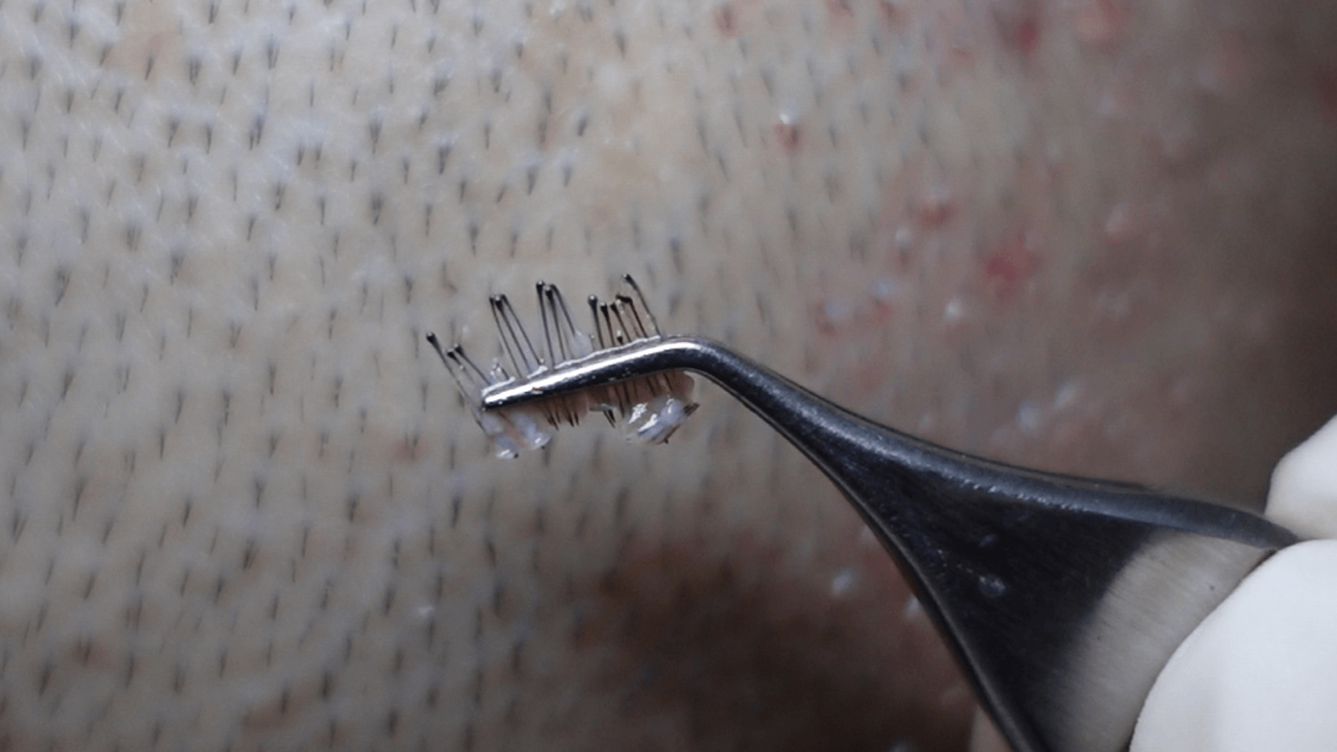 The grafts are sorted and surgically modified to match the existing hair.