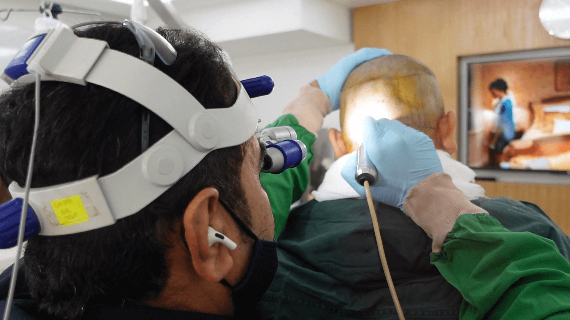 These grafts are extracted with precision using the SMART™ device that is only available in Glojas