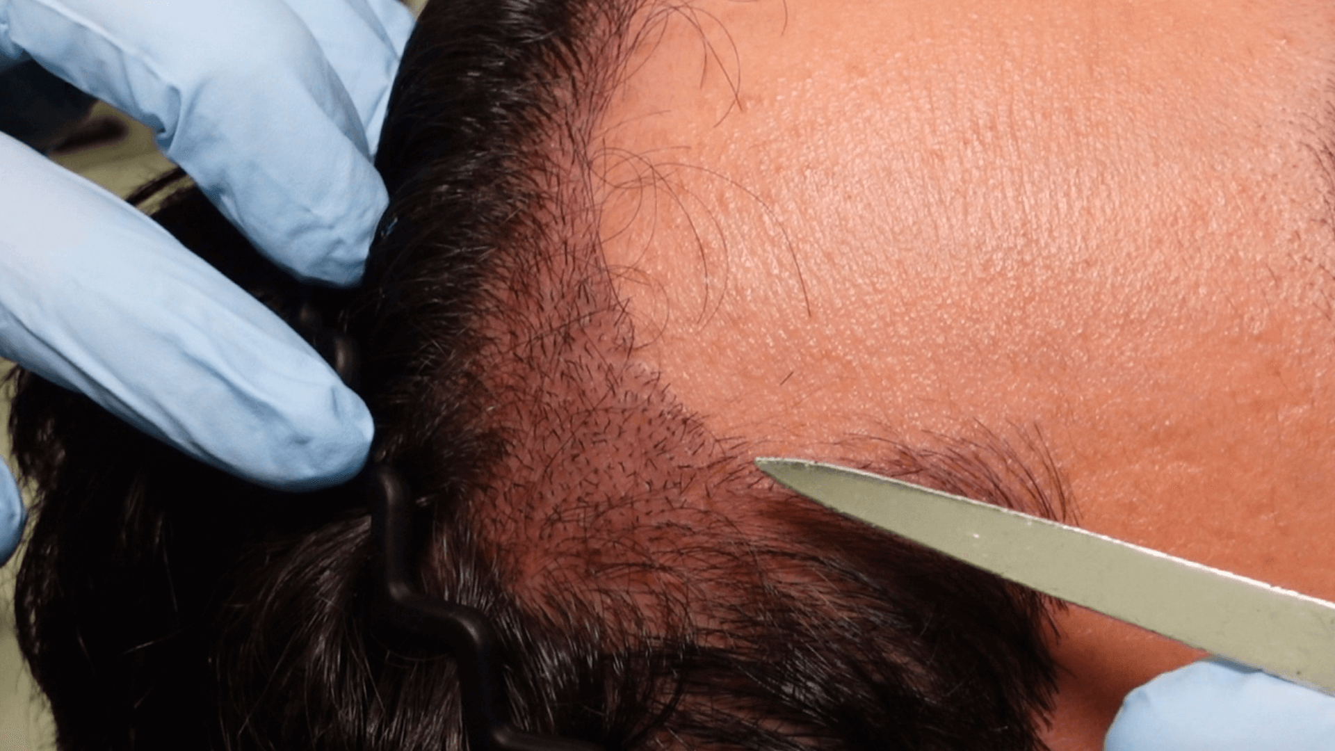 Planting grafts at the hair loss area