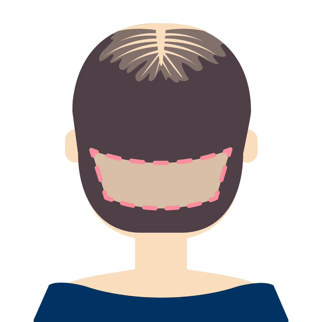 Beard Transplant