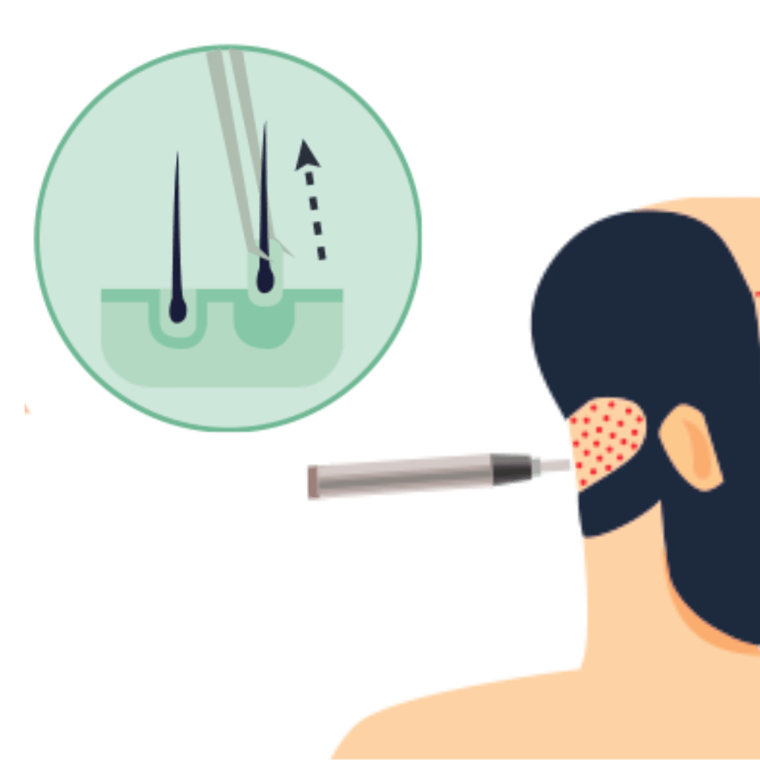Beard Transplant