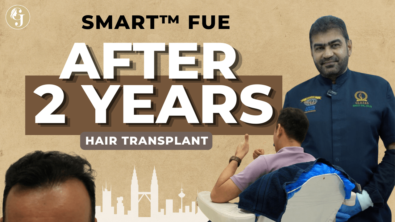 Male Pattern Hair Loss Level 4 (M-Shape)