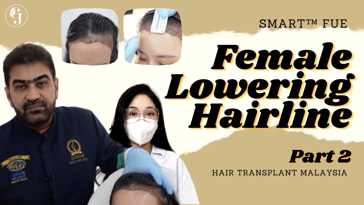 Penurunan Garis Rambut Untuk Perempuan (Bahagian 2) | TRANSPLANTASI RAMBUT MALAYSIA