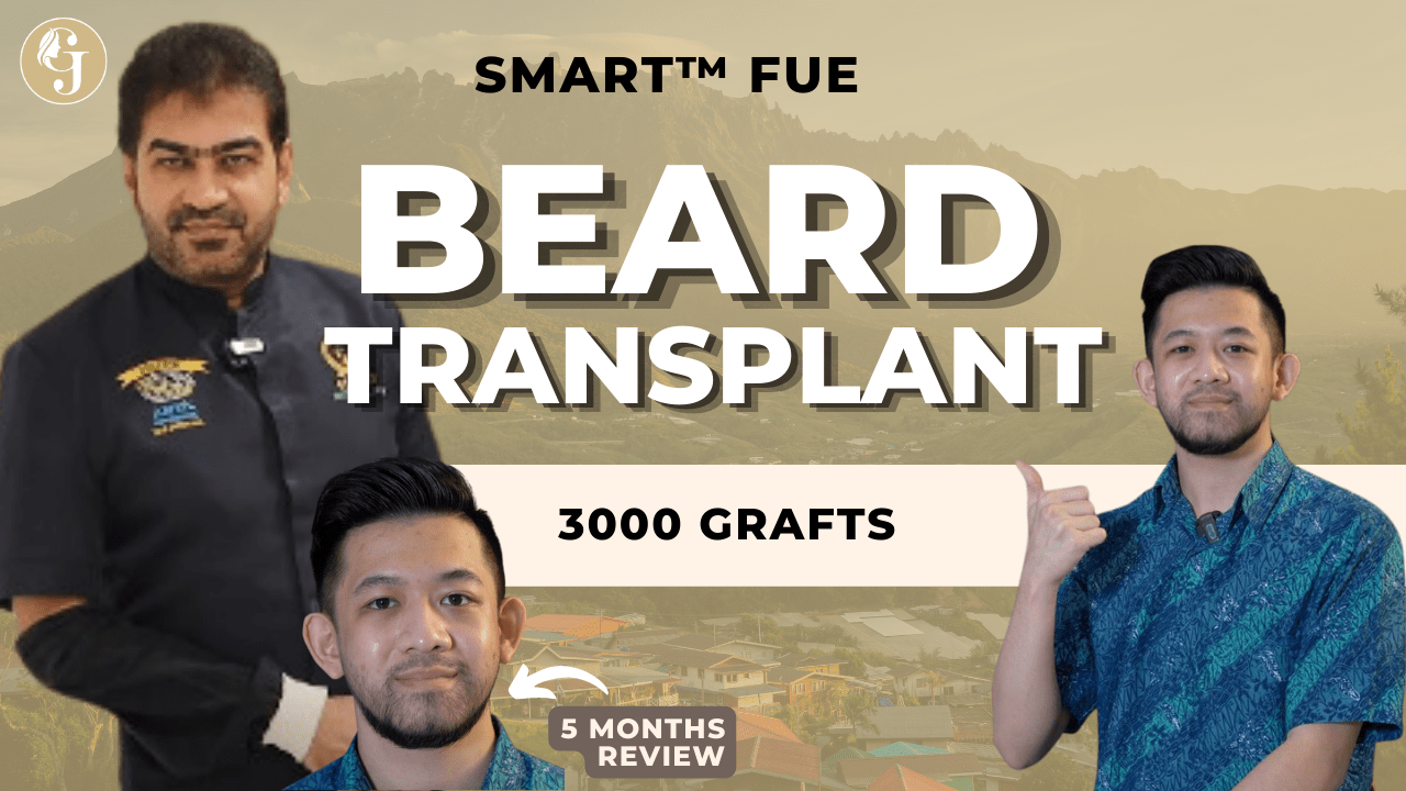 Transplantasi Rambut Janggut: 5 Bulan Selepas Transplantasi Rambut SMART™ FUE