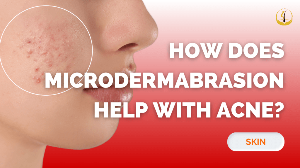 How Does Microdermabrasion Help With Acne? Glojas Specialist